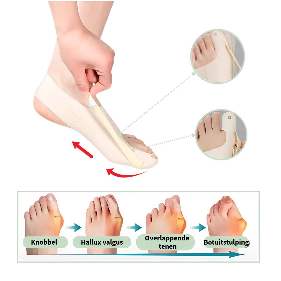Comfortabele Hallux Valgus Brace