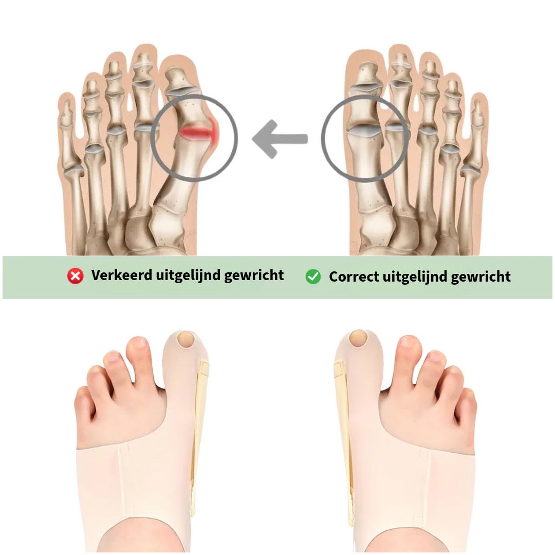 Comfortabele Hallux Valgus Brace