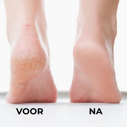 Professionele Eeltverwijderaar