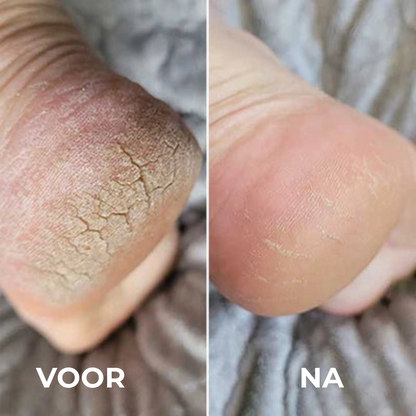 Professionele Eeltverwijderaar